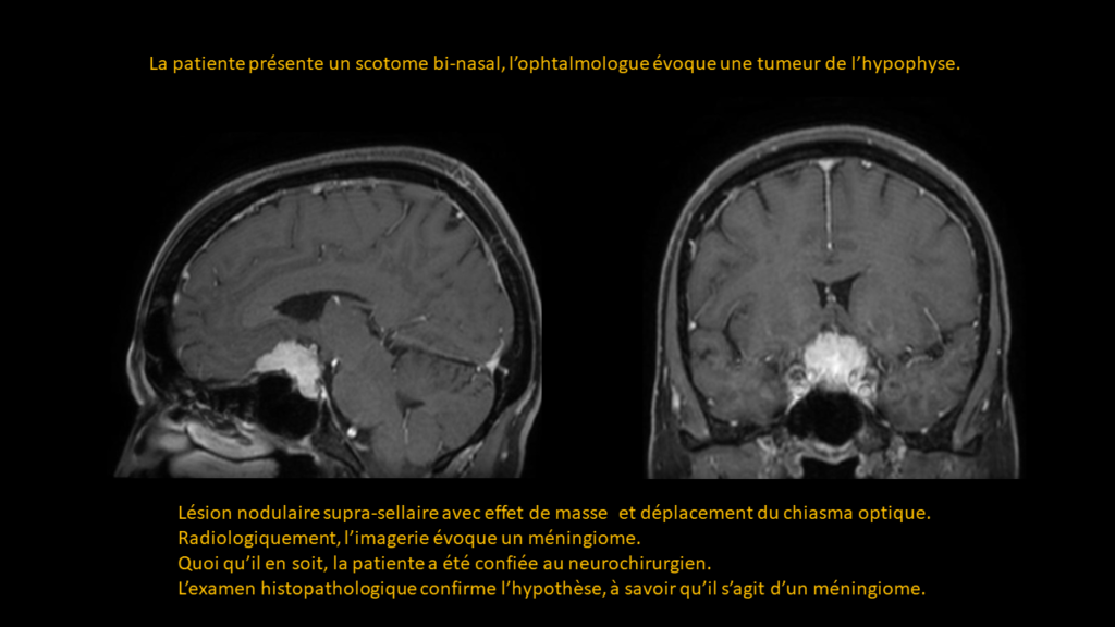 Resposta Meningioma
