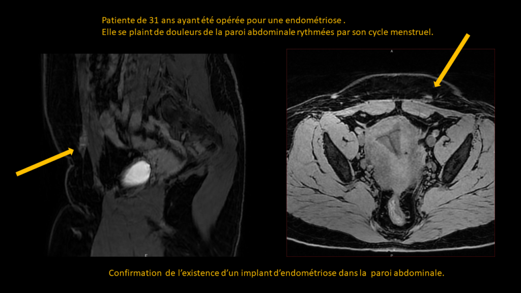 Resposta endometriose