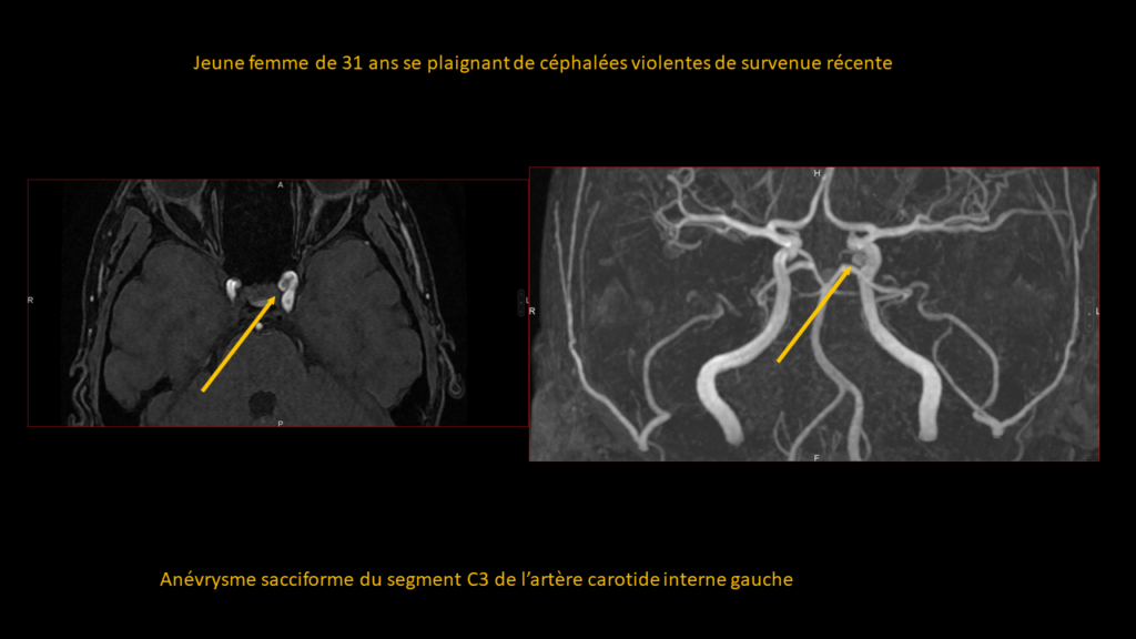 Resposta Aneurisma