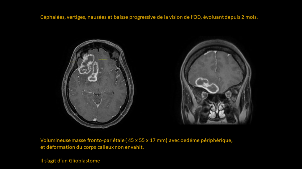 Resposta glioblastoma