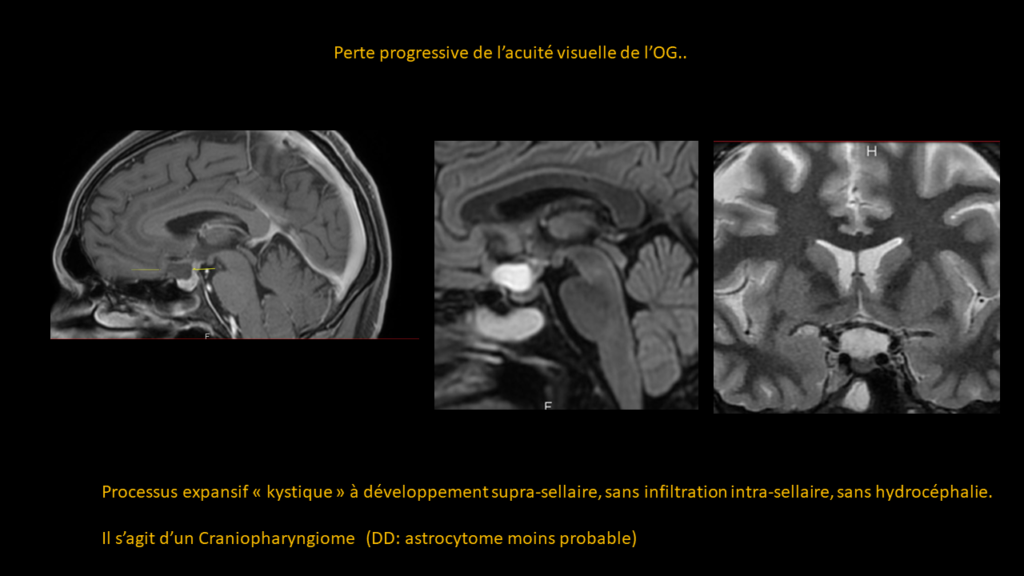 Resposta craniofaringioma