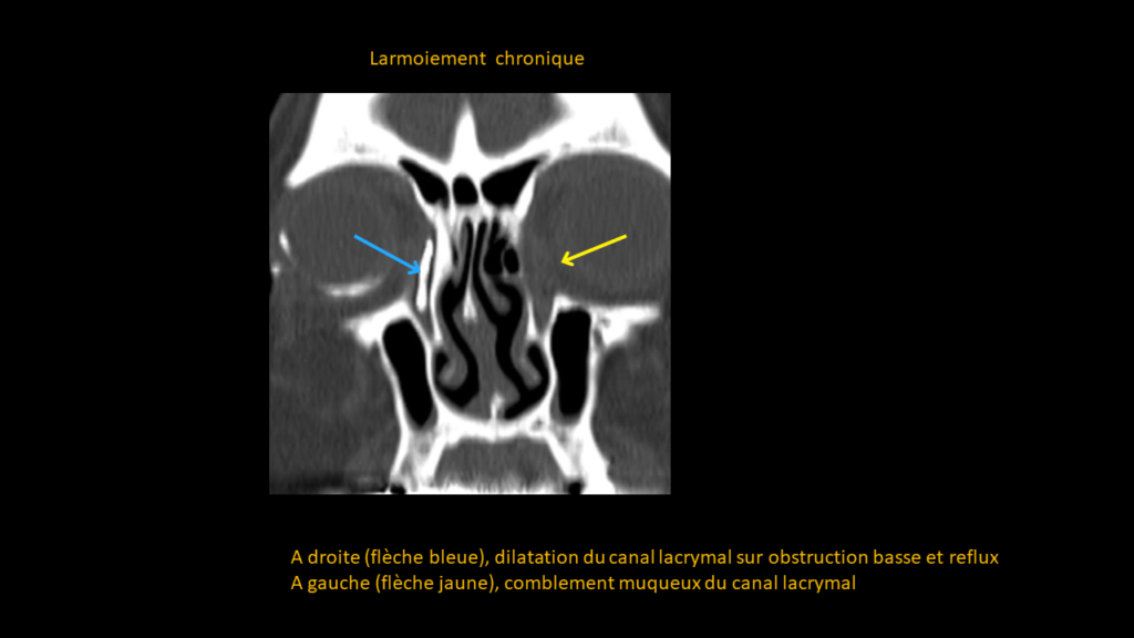 Resposta nasal