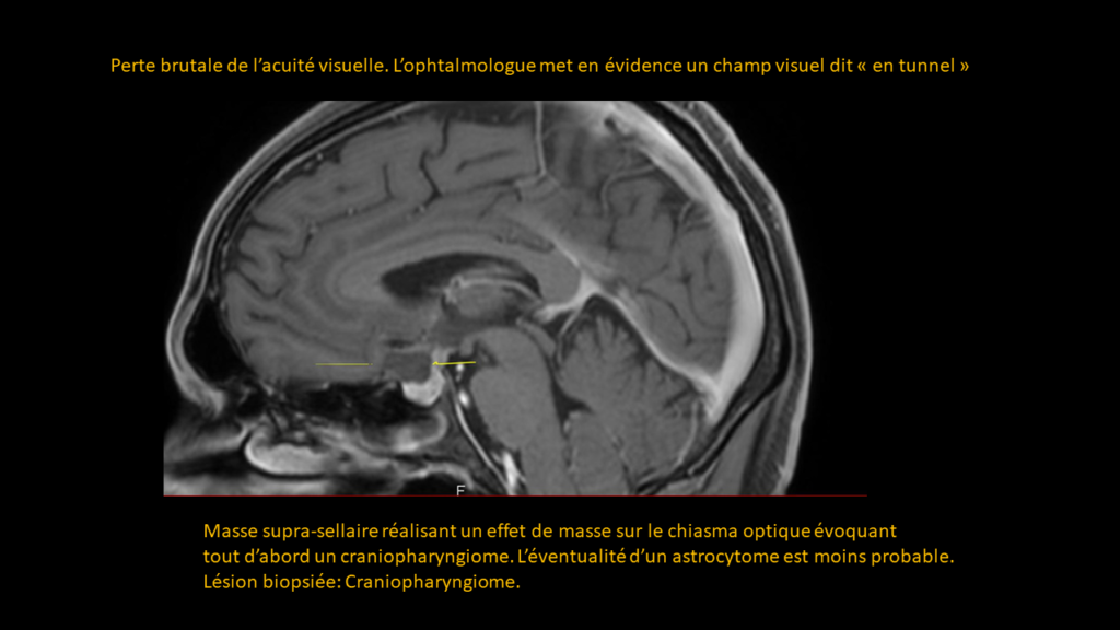 Respuesta Craneofaringioma