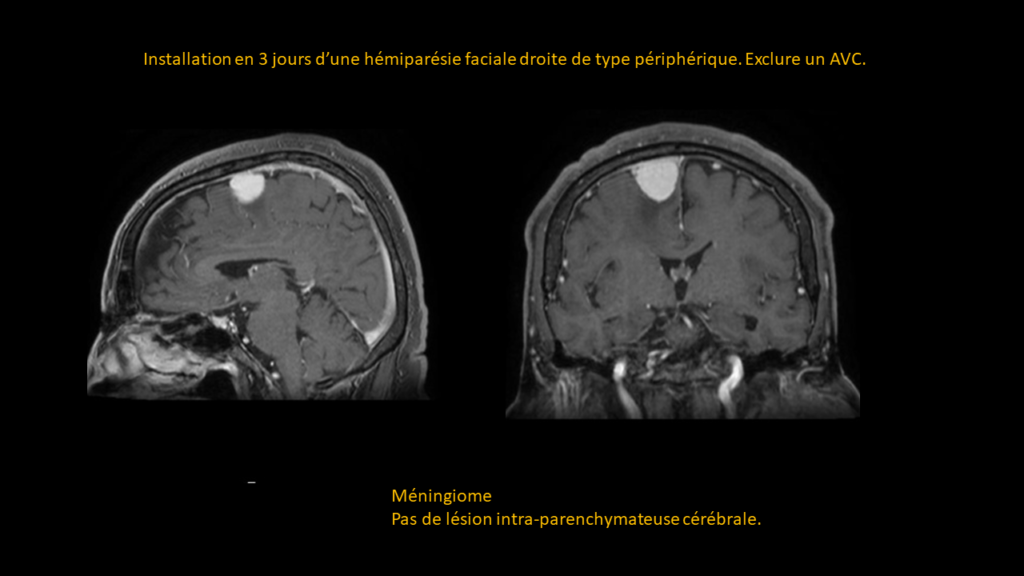 Resposta Meningioma